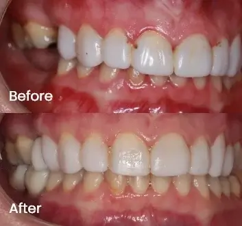Replacing Missing Teeth Case