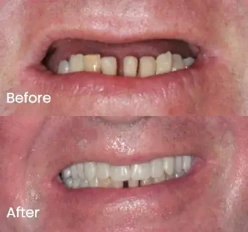 Replacing Missing Teeth Case