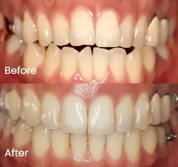 Orthodontics Case 42