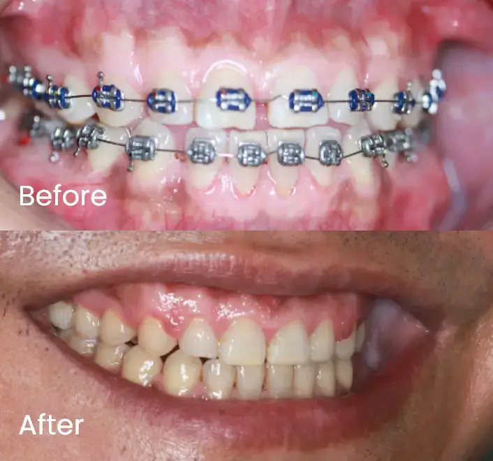 Comparison of teeth with braces