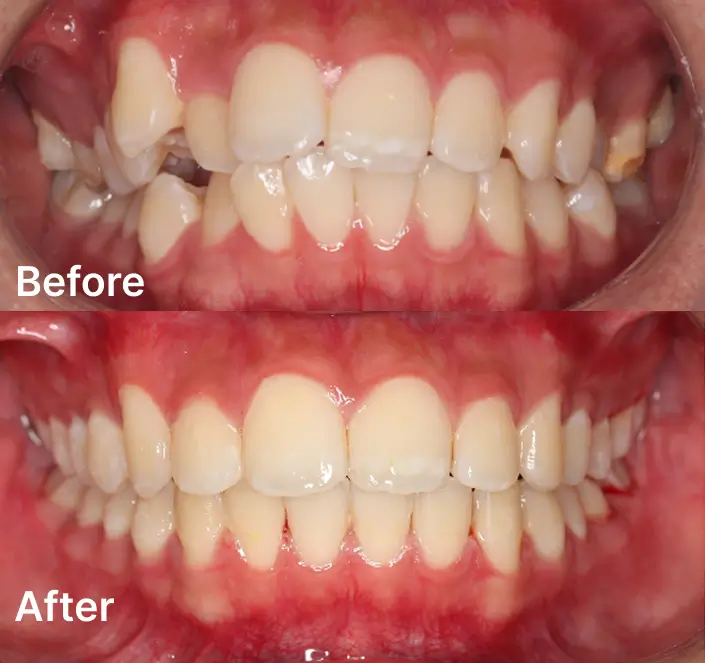 Orthodontics Case