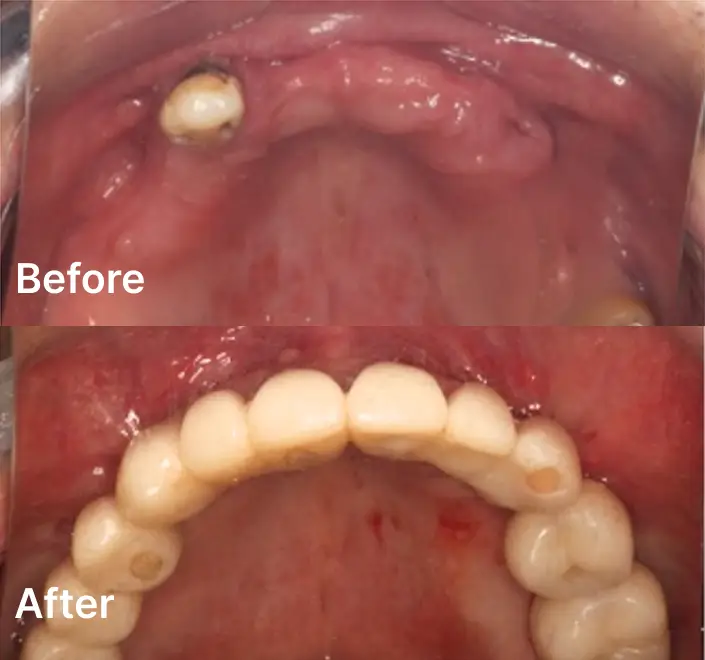 Replacing Missing Teeth Case