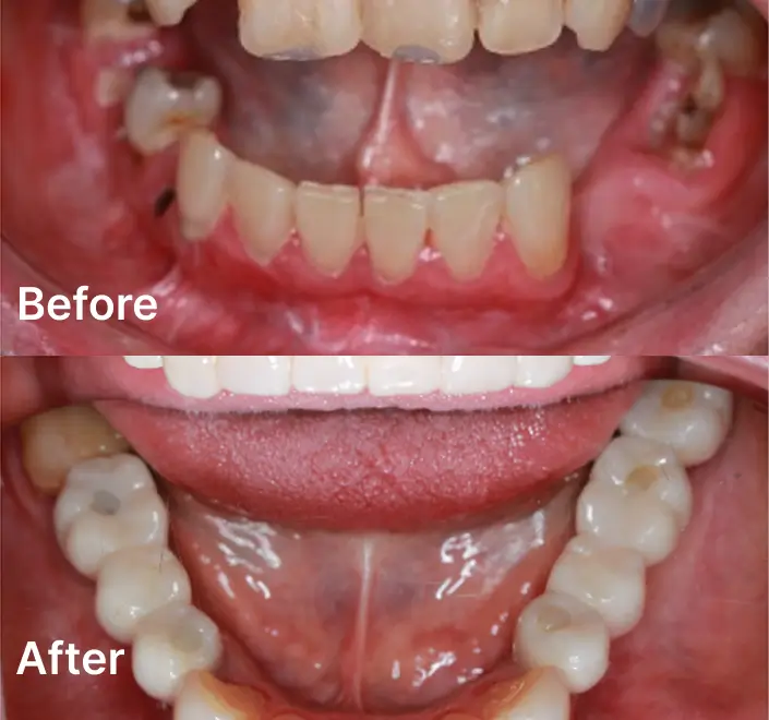 Replacing Missing Teeth Case