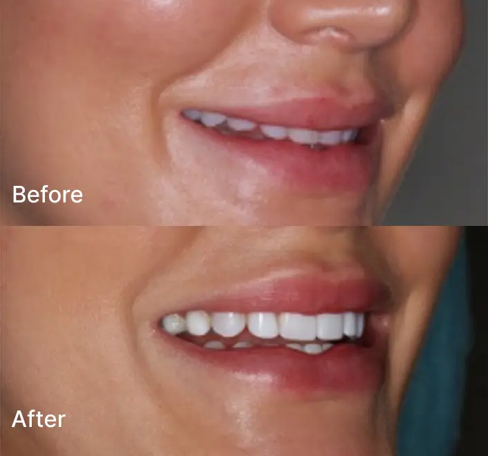 Smile Makeover Case 1