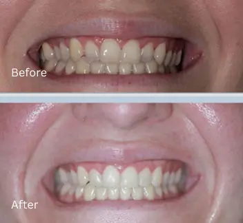 Smile Makeover Case 12