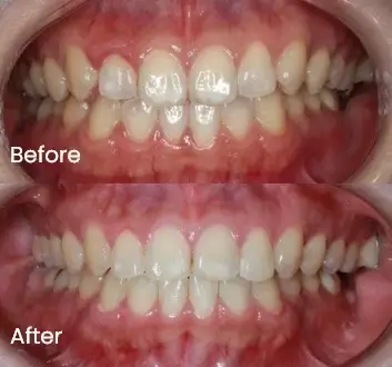 Orthodontics Case 43