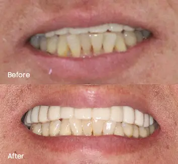 Smile Makeover Case 7