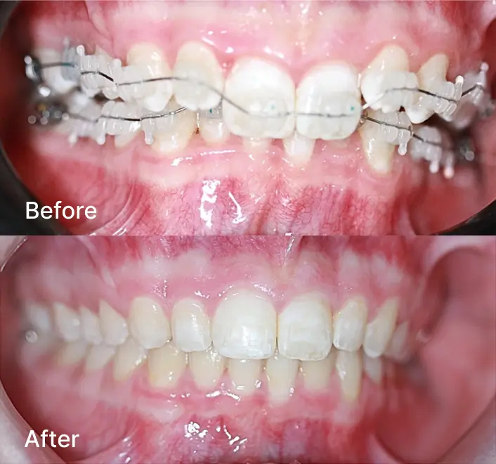Before and after comparison of teeth alignment