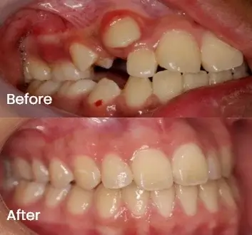 Close-up comparison of teeth alignment