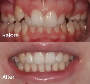 Teeth alignment comparison in before and after views
