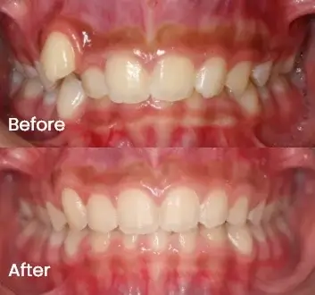 Teeth alignment shown before and after