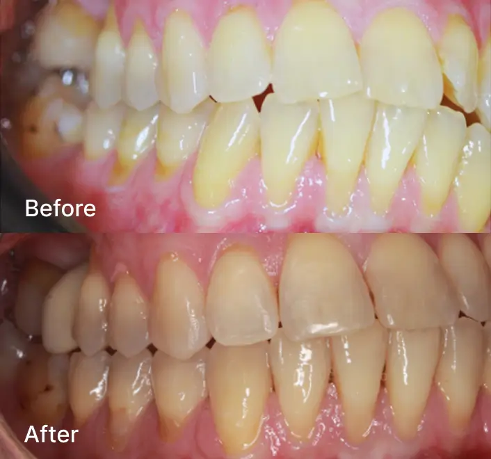 Teeth before and after alignment changes