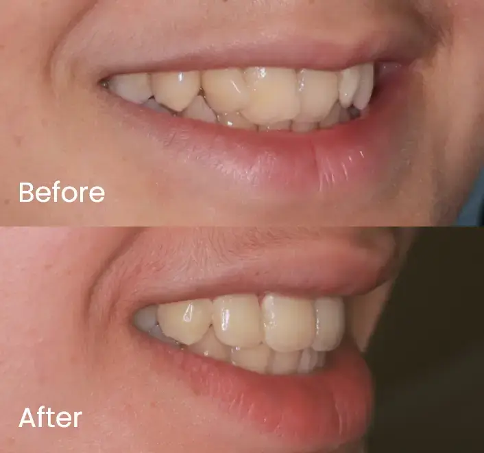 Teeth positioning comparison before and after