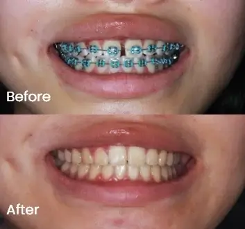 Comparison view of teeth with braces