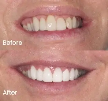 Smile Makeover Case 18