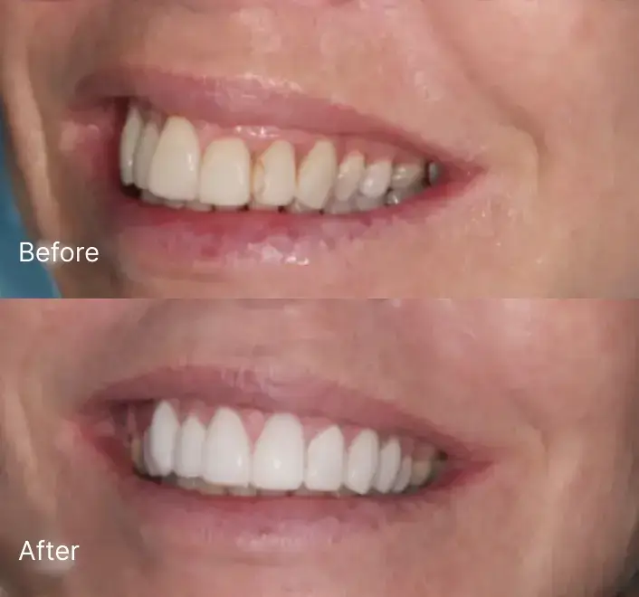 Smile Makeover Case 4