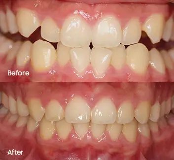 Orthodontics Case 37