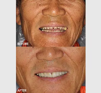 Smile Makeover Case 11