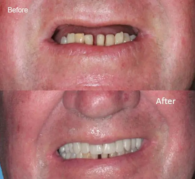 Smile Makeover Case 15