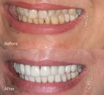 Smile Makeover Case 9