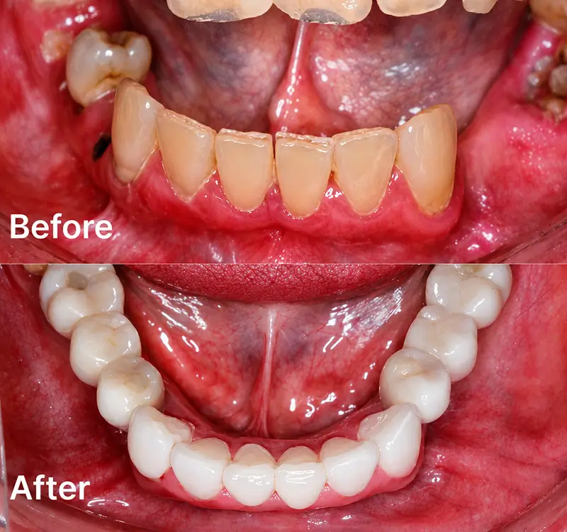 Before and after lower front teeth restoration