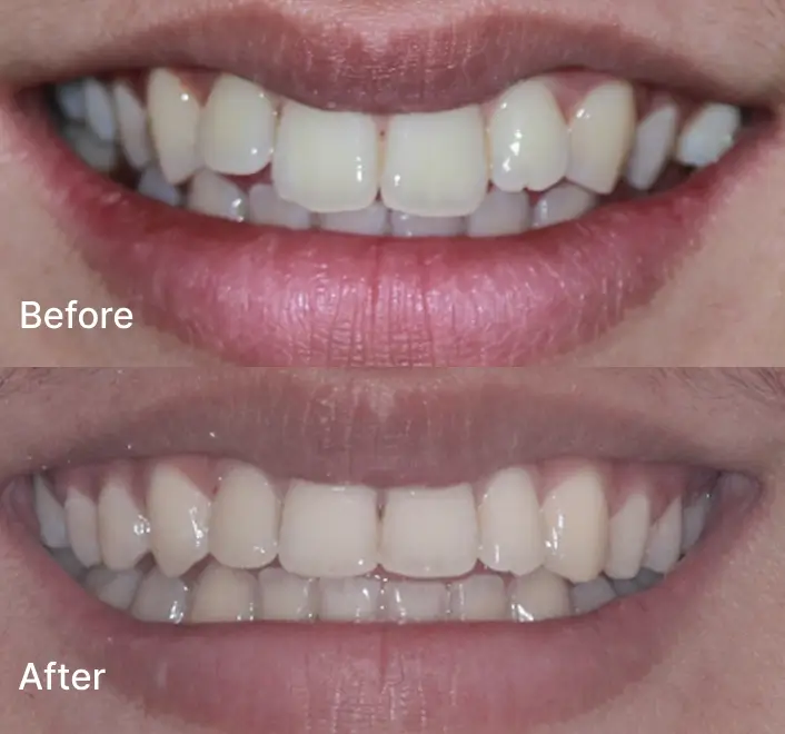 Before and after smile showing front teeth