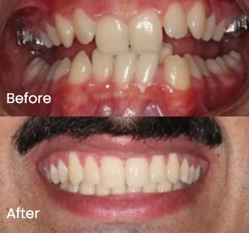 Before and after comparison of smile and teeth