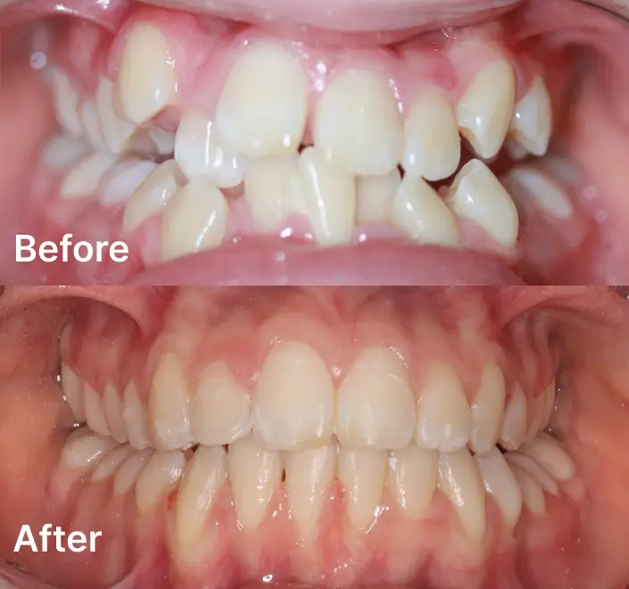 Before and after comparison of upper and lower teeth alignment