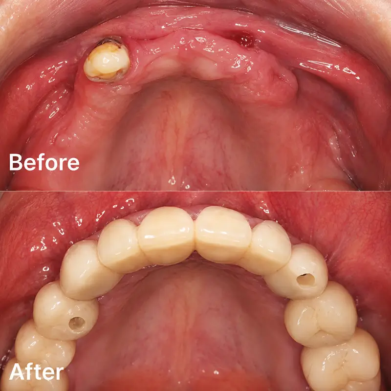 Before and after upper teeth restoration