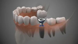 Result of a molar tooth implant installation after the surgery Result of a molar tooth implant installation after the surgery