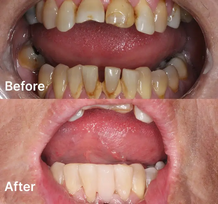 Before and after dentures treatment results