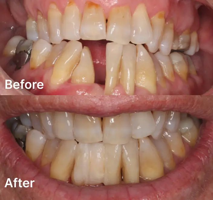 Before and after full mouth dental restoration results