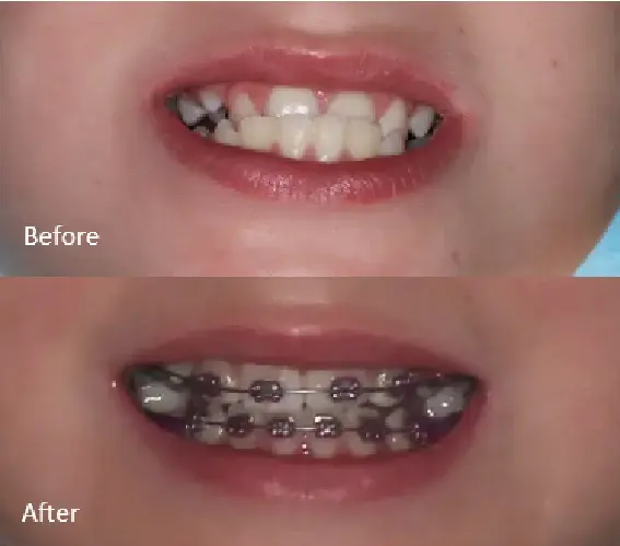 Orthodontics Case