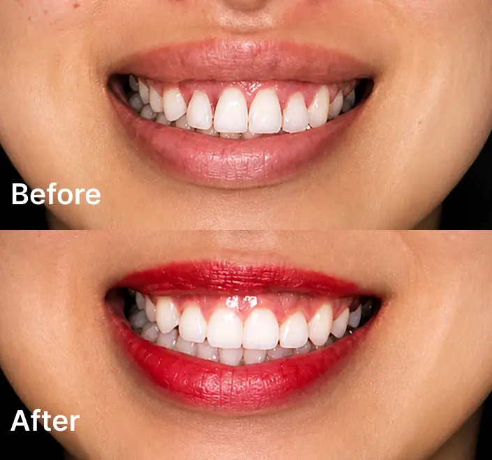 Before and after smile makeover results