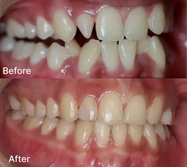 Before and after views of dental alignment