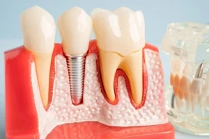 dental bone graft recovery with implant dental bone graft recovery with implant