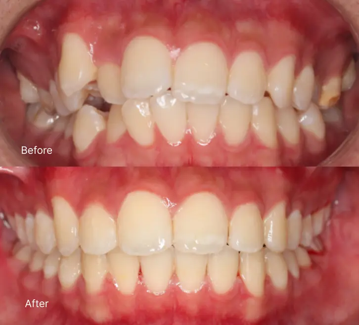 Before and after teeth alignment with orthodontic braces
